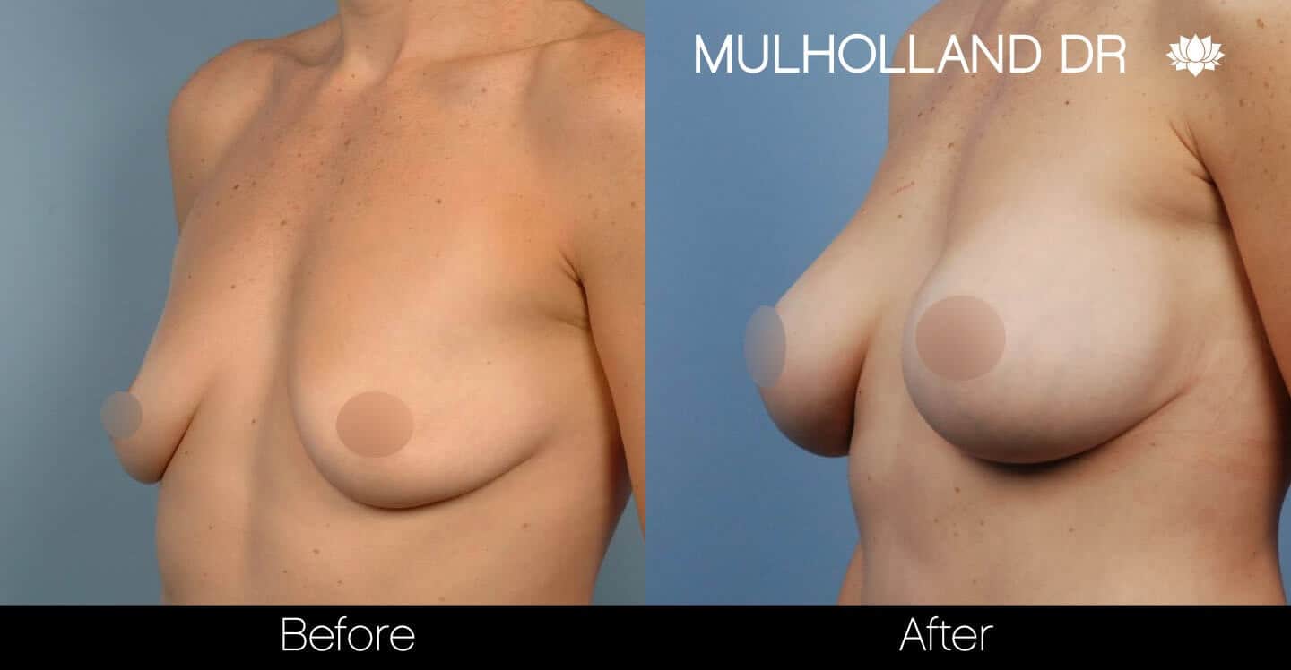 Breast Augmentation - Before and After Gallery – Photo 39