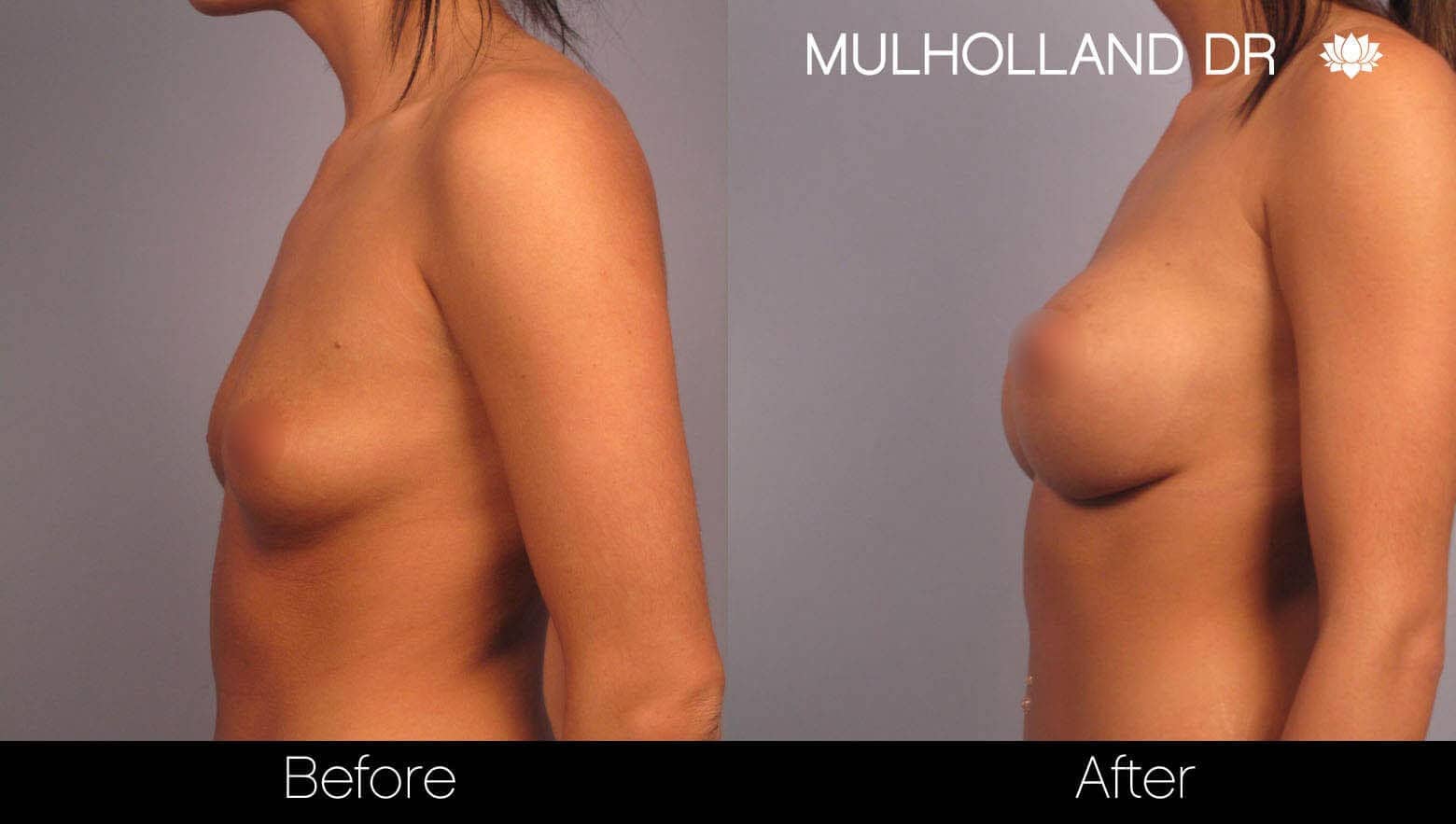 Breast Augmentation - Before and After Gallery – Photo 3