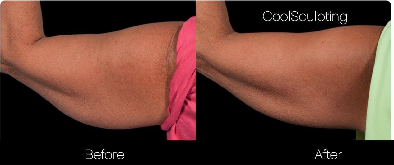 CoolSculpting - Before and After Gallery – Photo 40