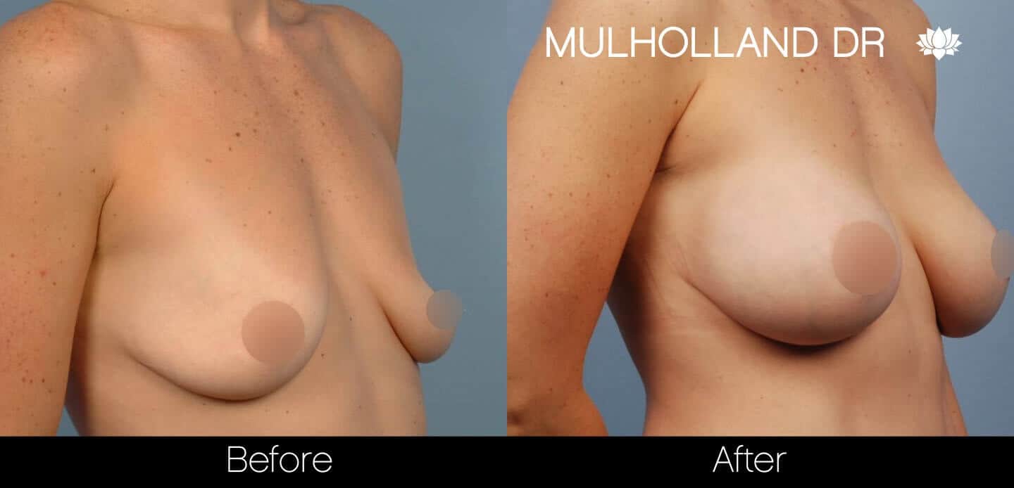 Breast Augmentation - Before and After Gallery – Photo 40