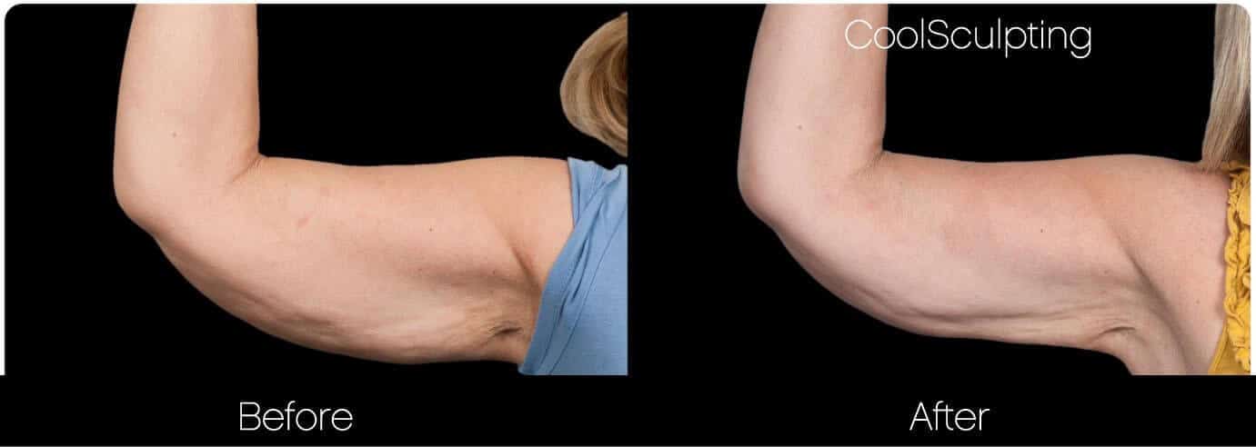 CoolSculpting - Before and After Gallery – Photo 41