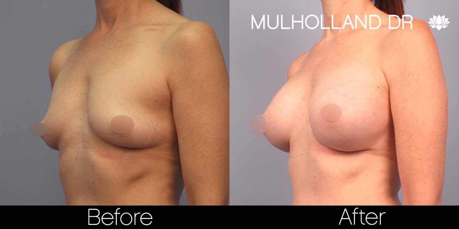 Breast Augmentation - Before and After Gallery – Photo 41