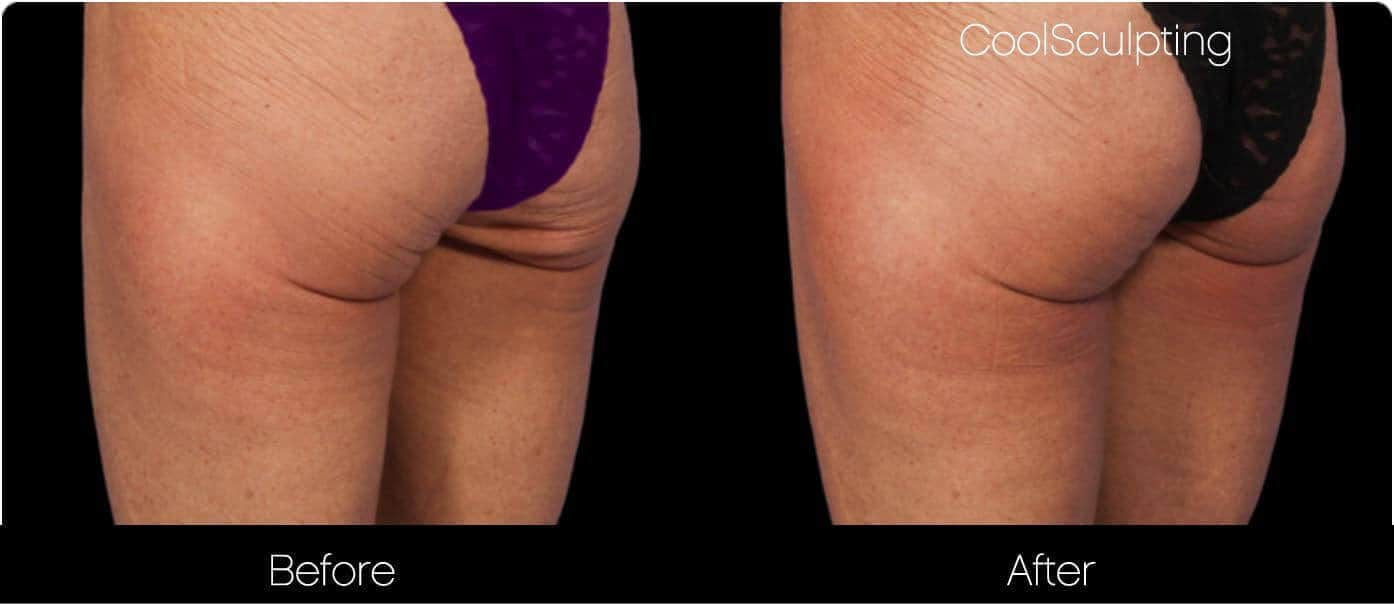 CoolSculpting - Before and After Gallery – Photo 42