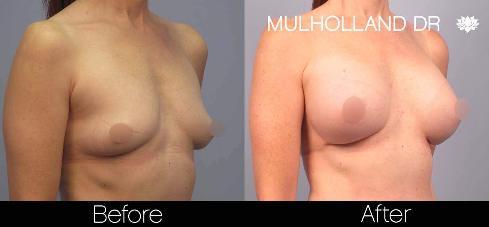 Breast Augmentation - Before and After Gallery – Photo 42
