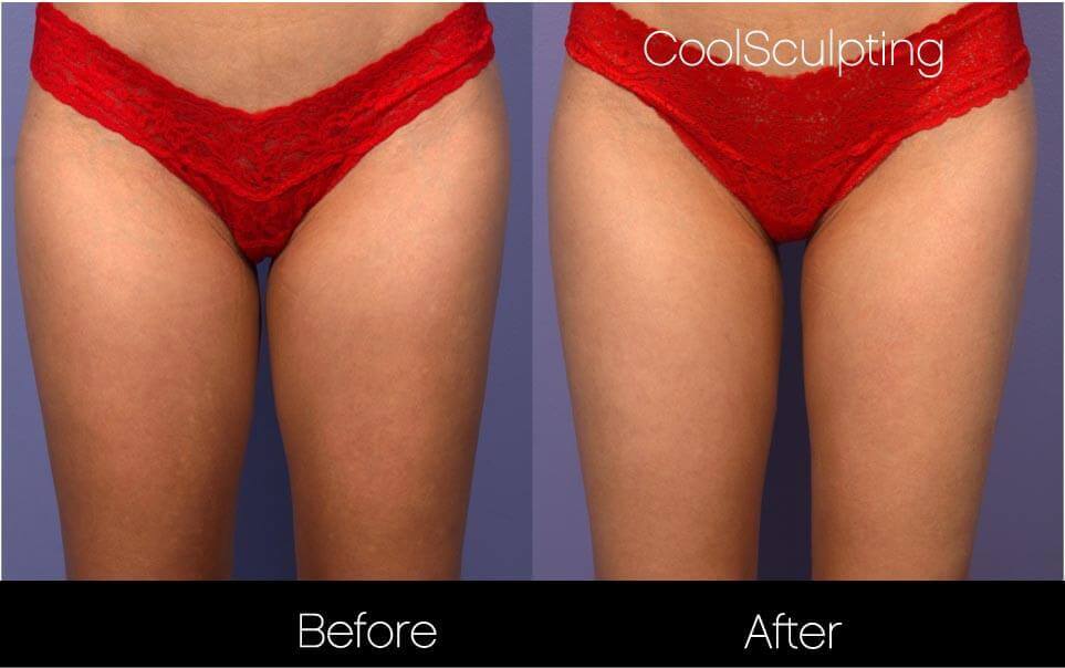 CoolSculpting - Before and After Gallery – Photo 43