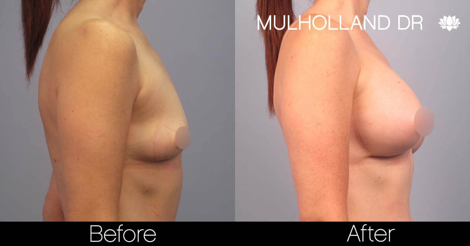 Breast Augmentation - Before and After Gallery – Photo 43
