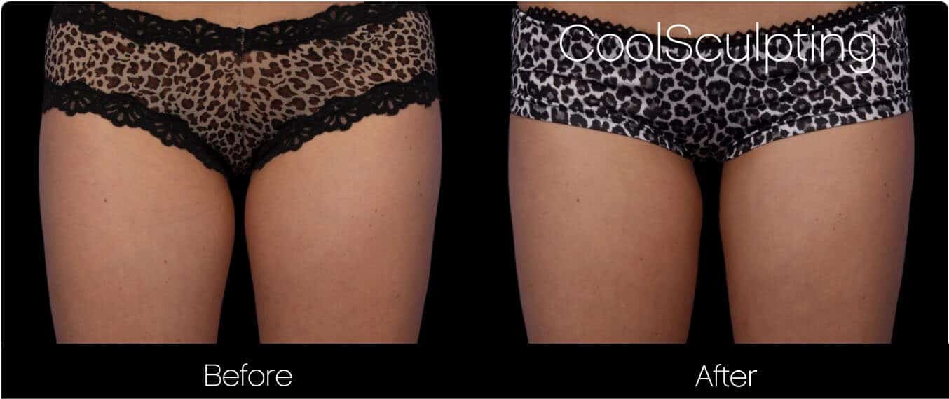 CoolSculpting - Before and After Gallery – Photo 44