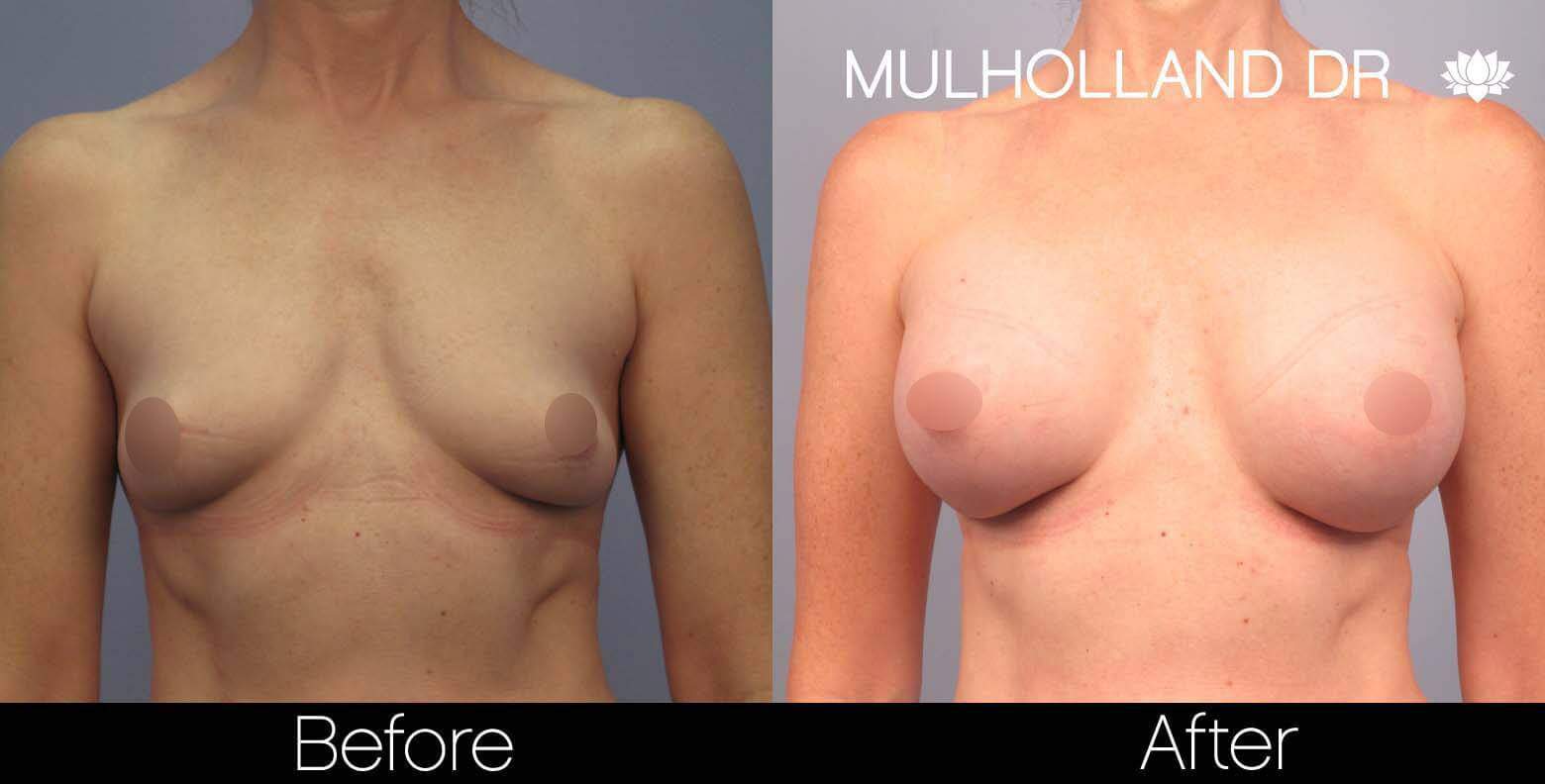 Breast Augmentation - Before and After Gallery – Photo 44
