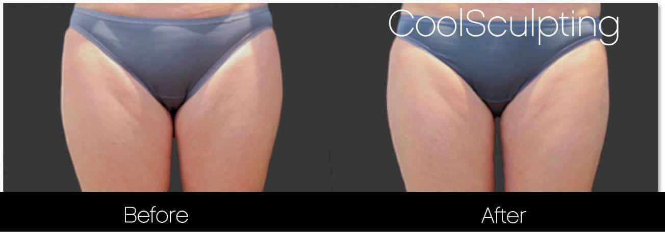 CoolSculpting - Before and After Gallery – Photo 45
