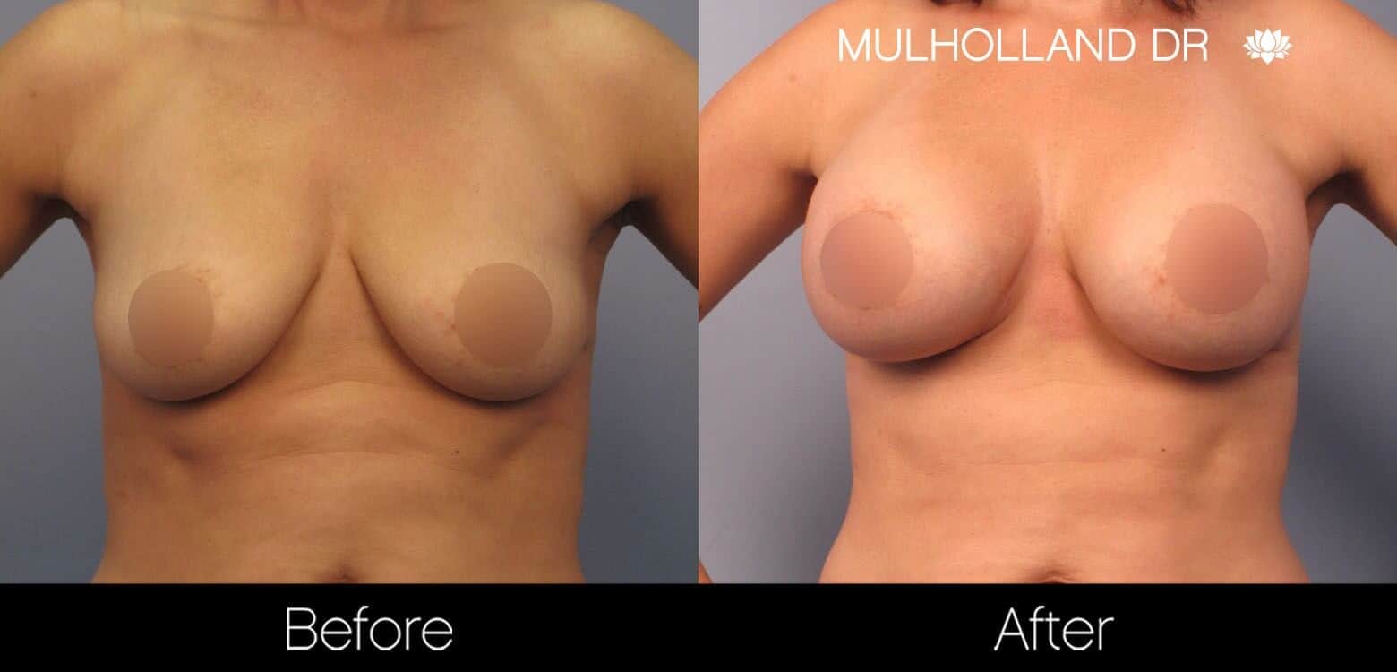 Breast Augmentation - Before and After Gallery – Photo 45