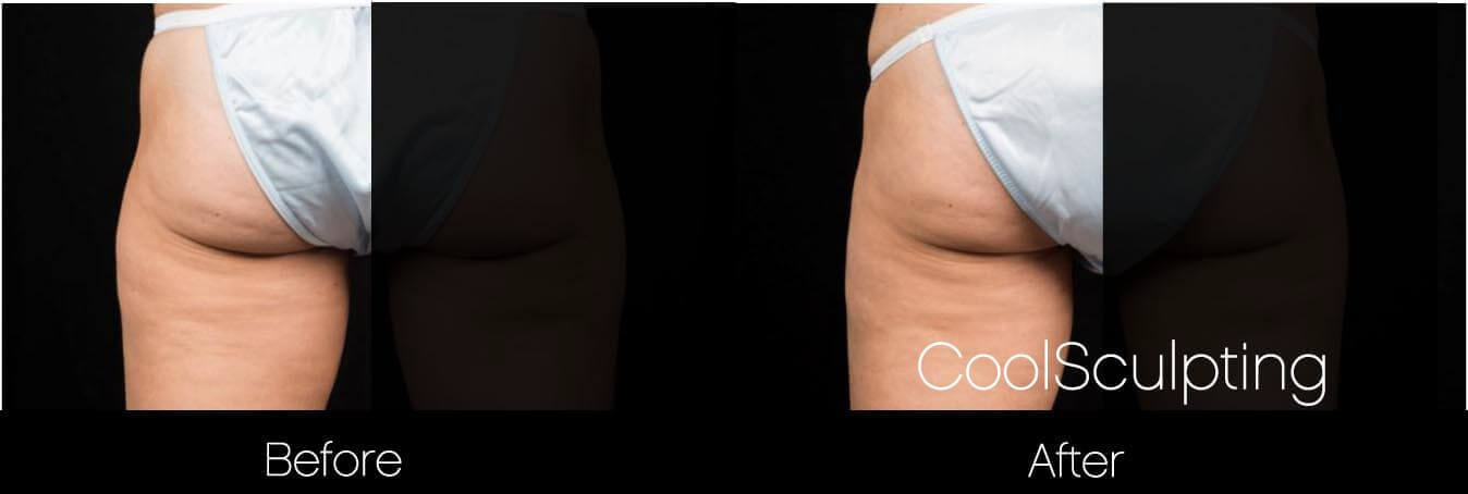 CoolSculpting - Before and After Gallery – Photo 46