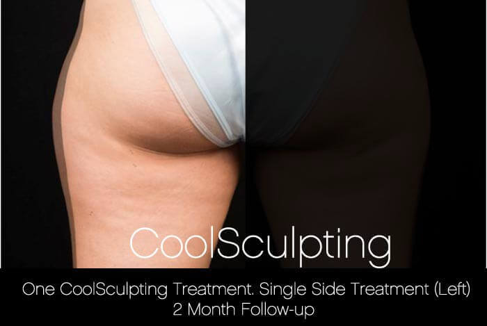 CoolSculpting - Before and After Gallery – Photo 48