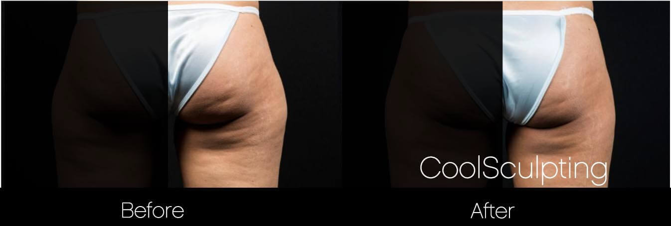 CoolSculpting - Before and After Gallery – Photo 47