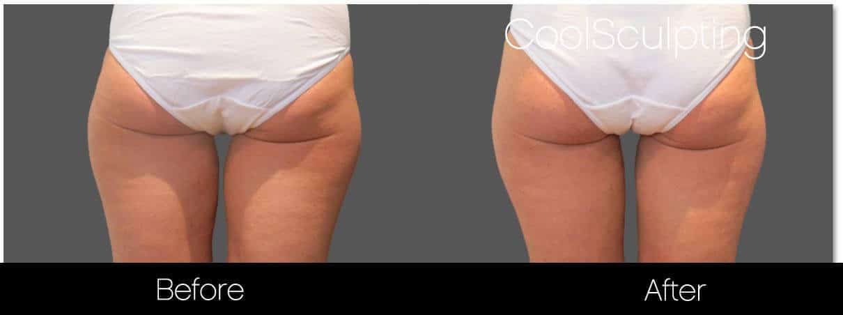 CoolSculpting - Before and After Gallery – Photo 49