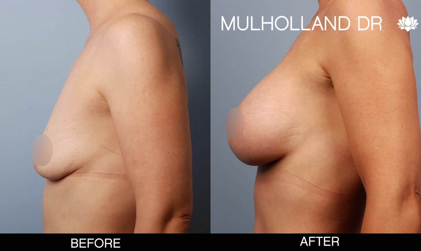 Breast Augmentation - Before and After Gallery – Photo 49