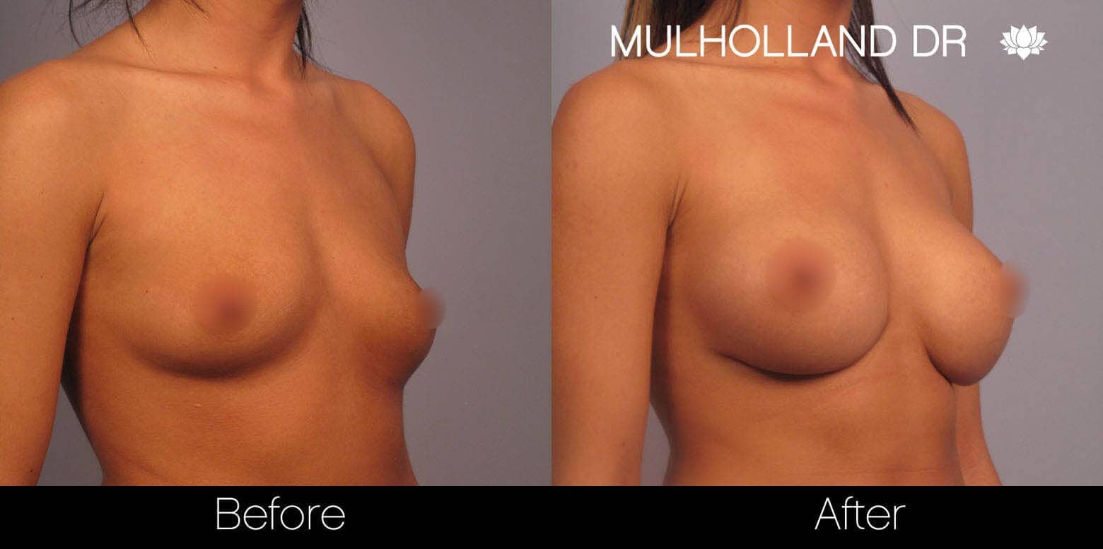 Breast Augmentation - Before and After Gallery – Photo 4