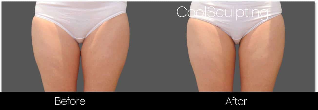 CoolSculpting - Before and After Gallery – Photo 50