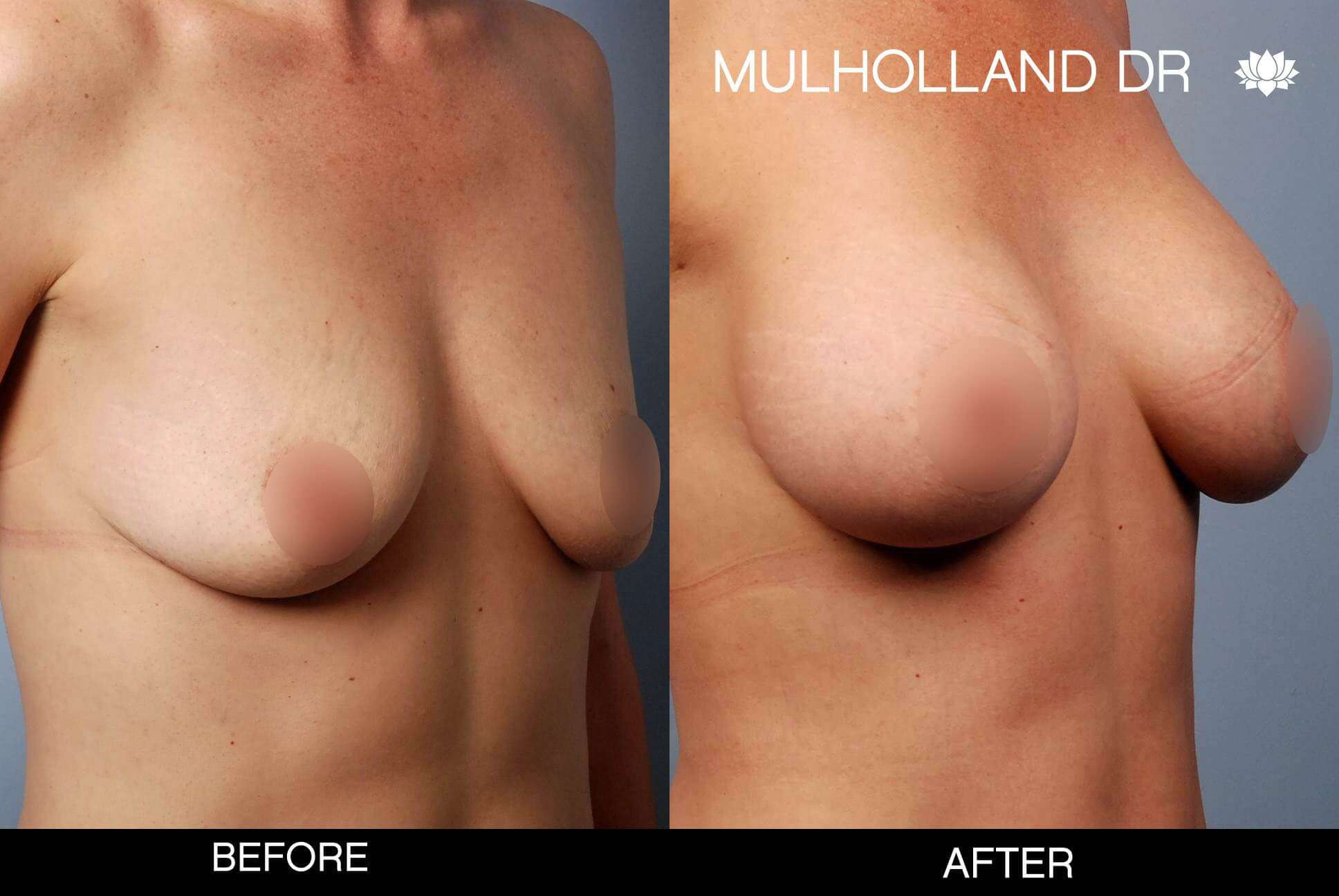 Breast Augmentation - Before and After Gallery – Photo 50