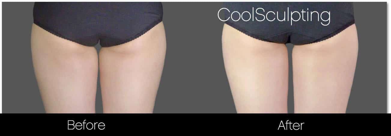 CoolSculpting - Before and After Gallery – Photo 51