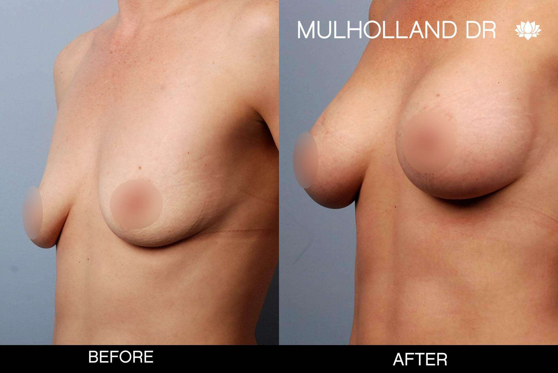 Breast Augmentation - Before and After Gallery – Photo 51