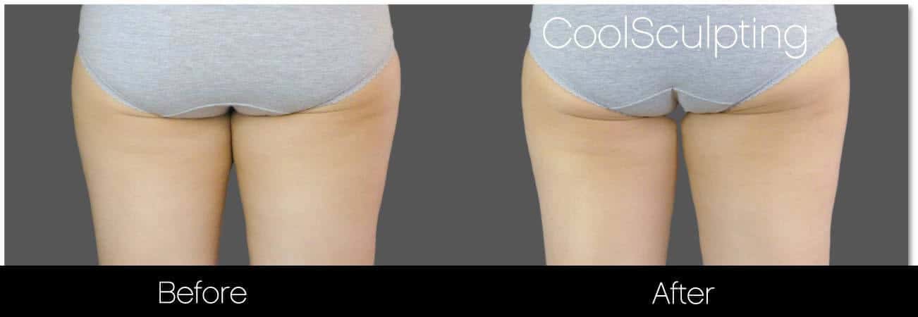 CoolSculpting - Before and After Gallery – Photo 52