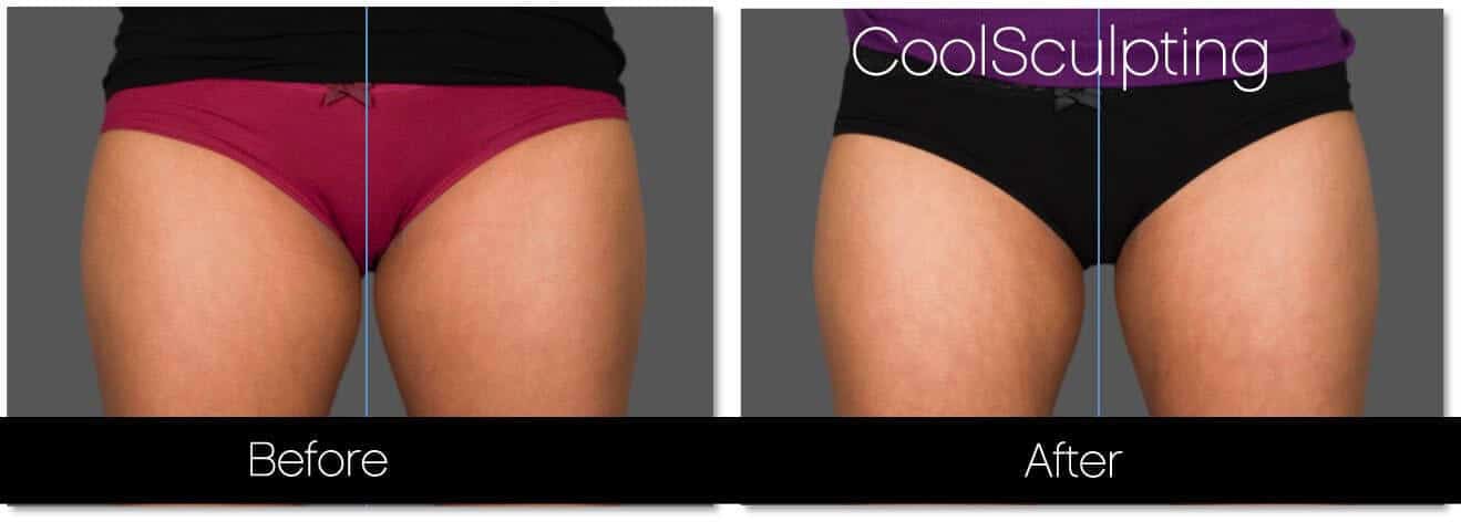 CoolSlim Stomach Wrap. Stomach Firming Treatment