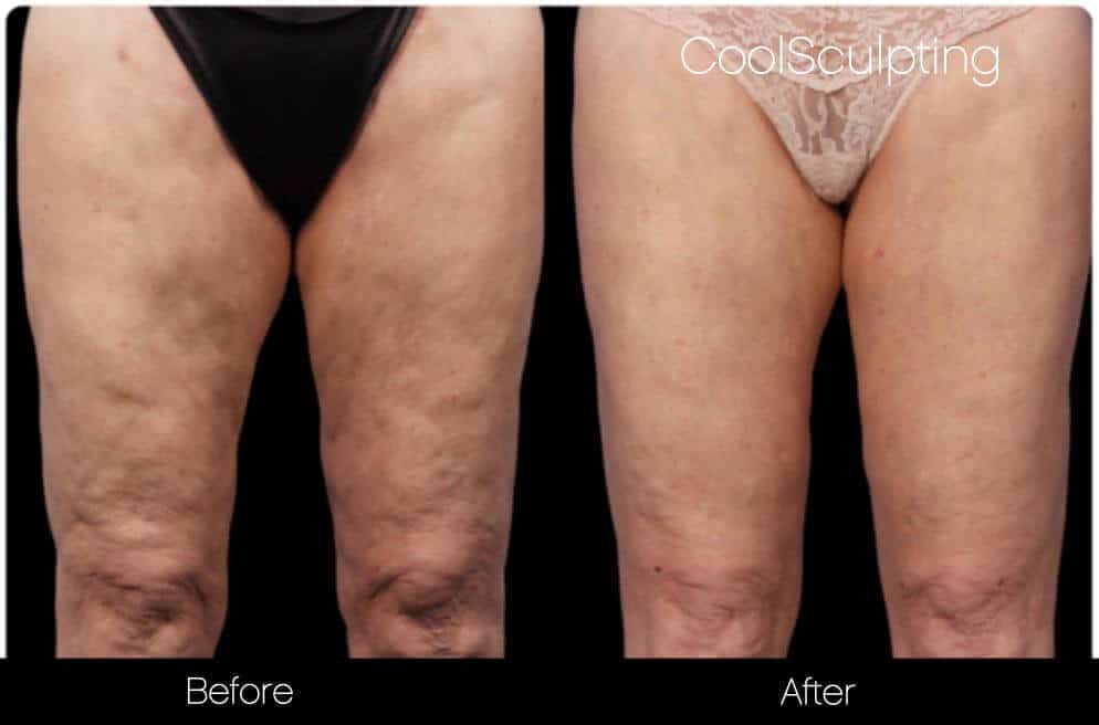 CoolSculpting - Before and After Gallery – Photo 54