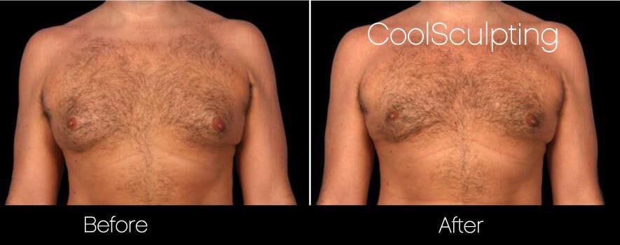 CoolSculpting - Before and After Gallery – Photo 55