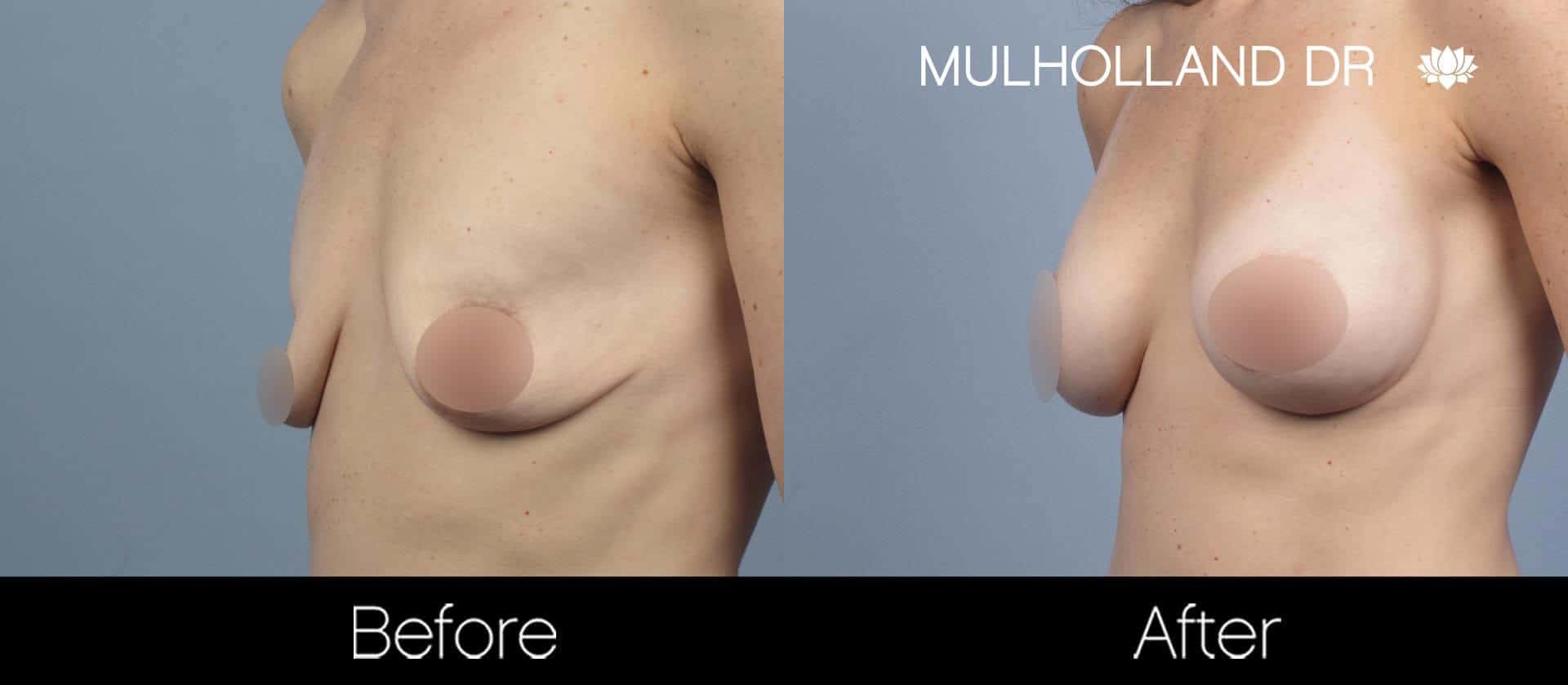 Breast Augmentation - Before and After Gallery – Photo 55