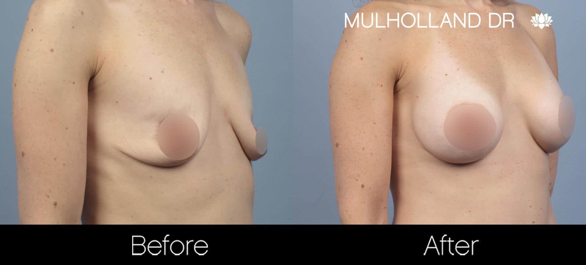 Breast Augmentation - Before and After Gallery – Photo 56