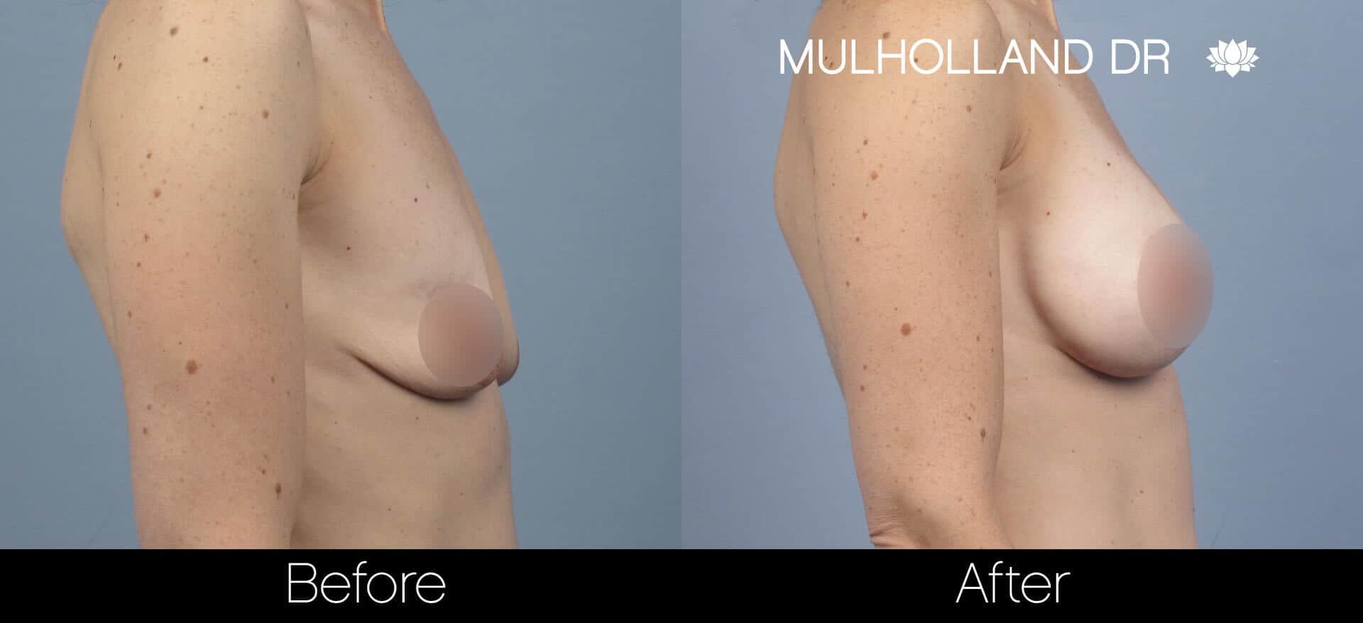 Breast Augmentation - Before and After Gallery – Photo 57