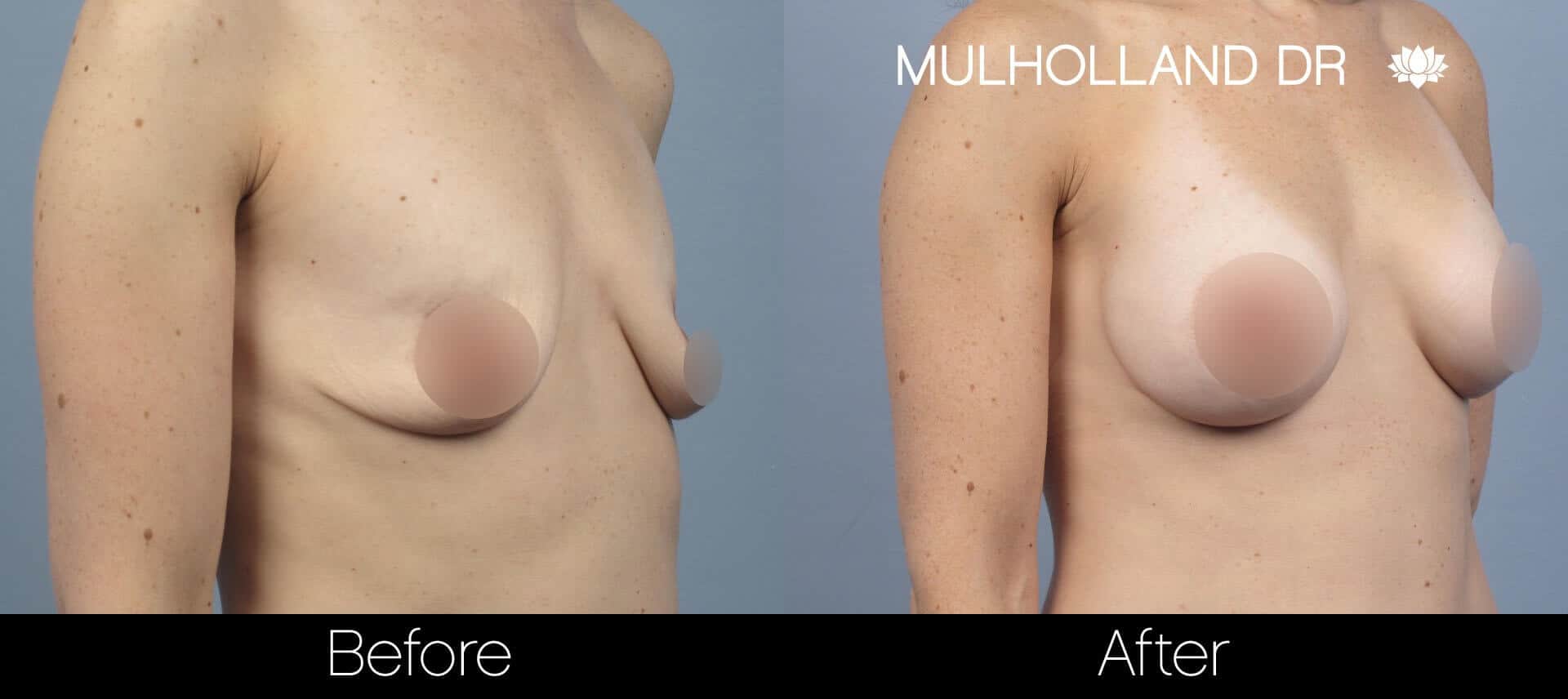 Breast Augmentation - Before and After Gallery – Photo 58