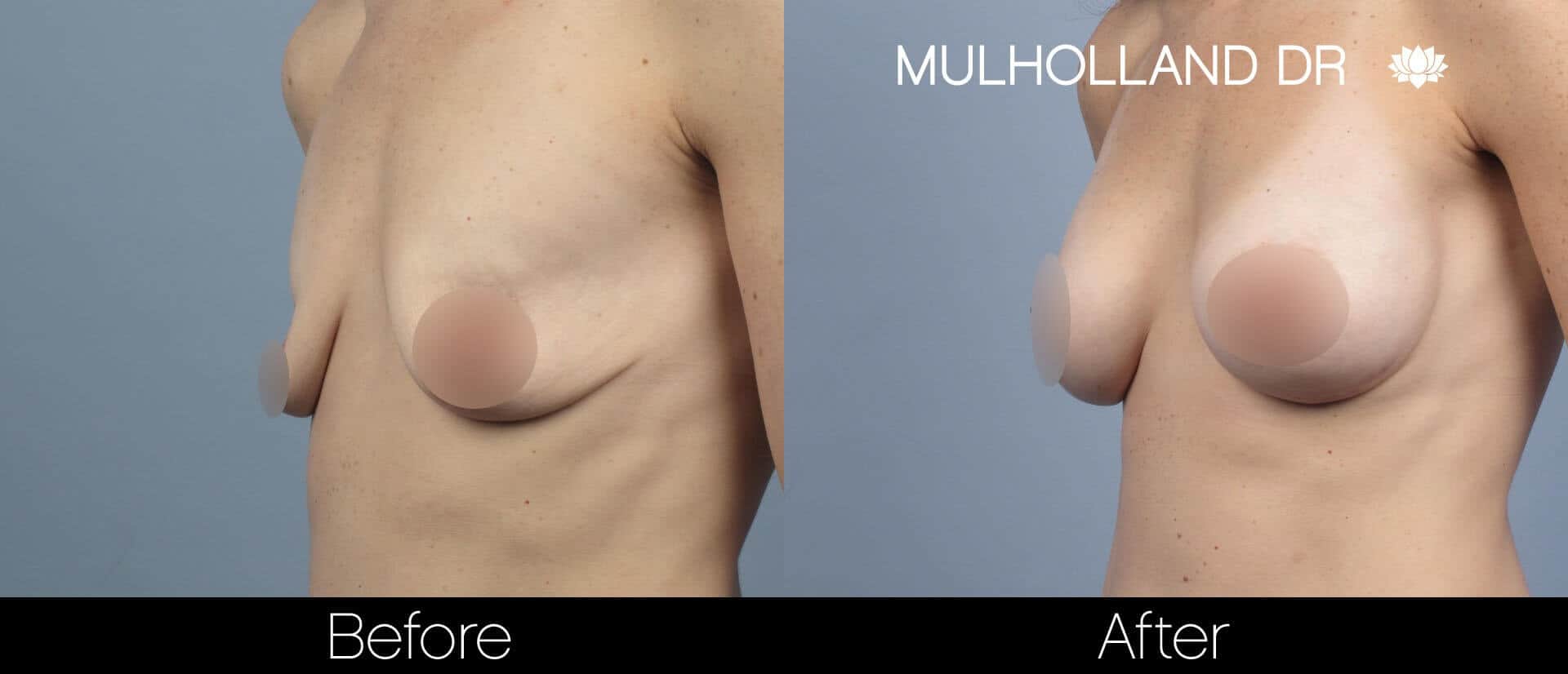 Breast Augmentation - Before and After Gallery – Photo 59