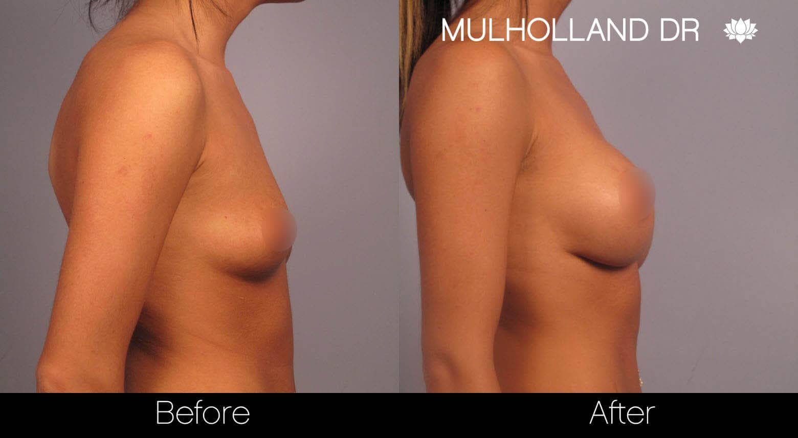 Breast Augmentation - Before and After Gallery – Photo 5