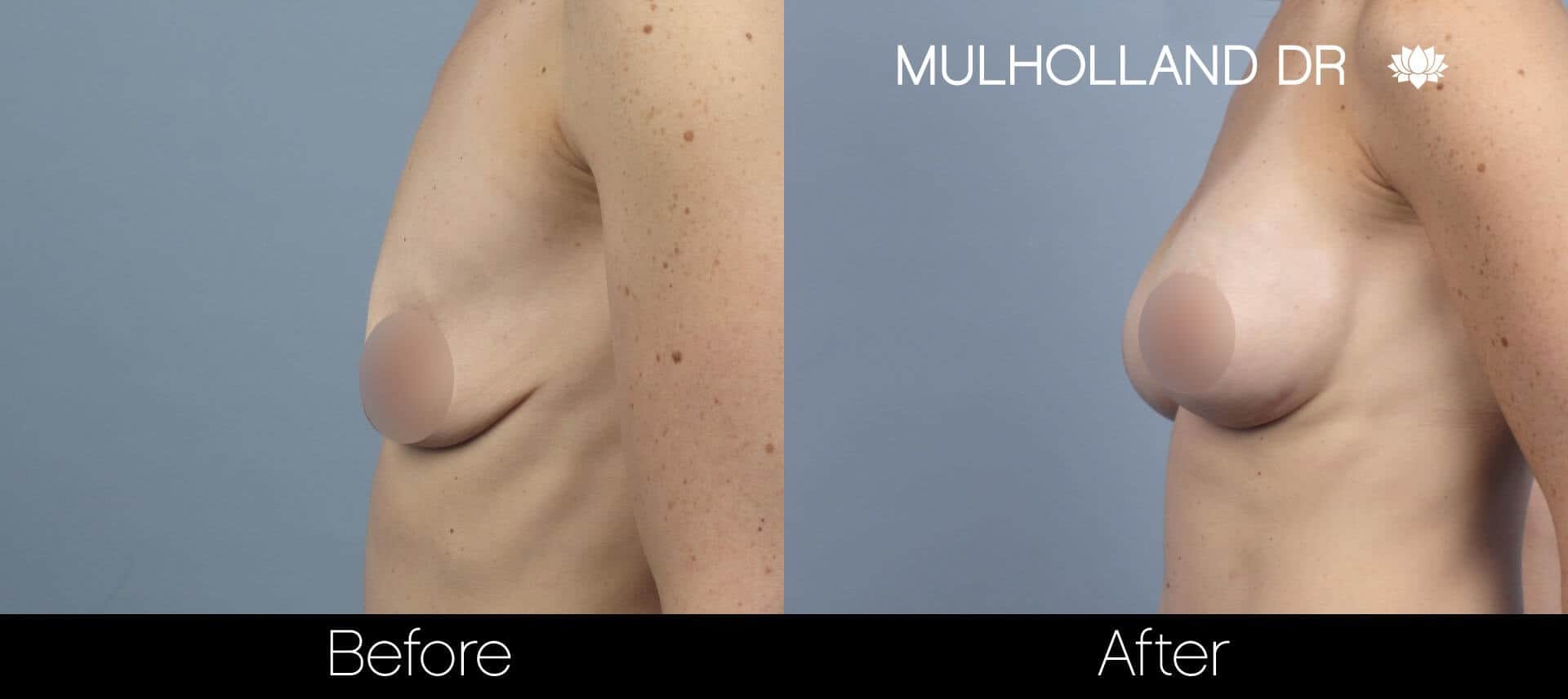 Breast Augmentation - Before and After Gallery – Photo 60