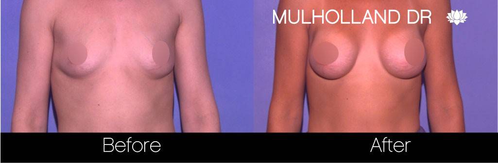 Breast Augmentation - Before and After Gallery – Photo 61