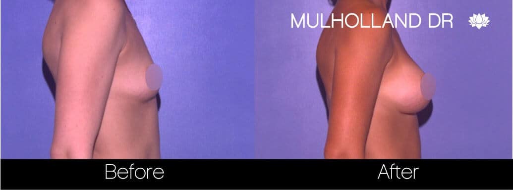 Breast Augmentation - Before and After Gallery – Photo 62
