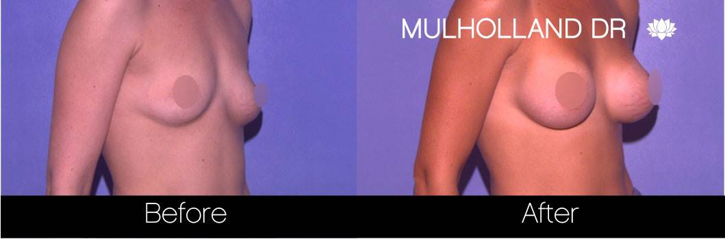 Breast Augmentation - Before and After Gallery – Photo 63