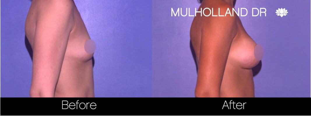 Breast Augmentation - Before and After Gallery – Photo 64