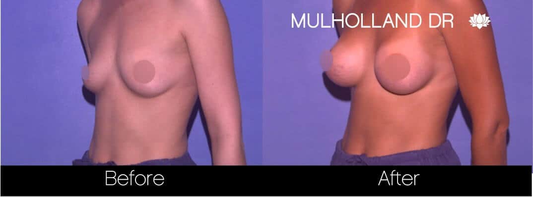 Breast Augmentation - Before and After Gallery – Photo 65