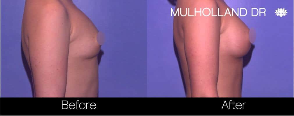 Breast Augmentation - Before and After Gallery – Photo 67