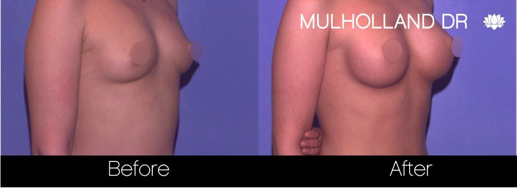 Breast Augmentation - Before and After Gallery – Photo 68