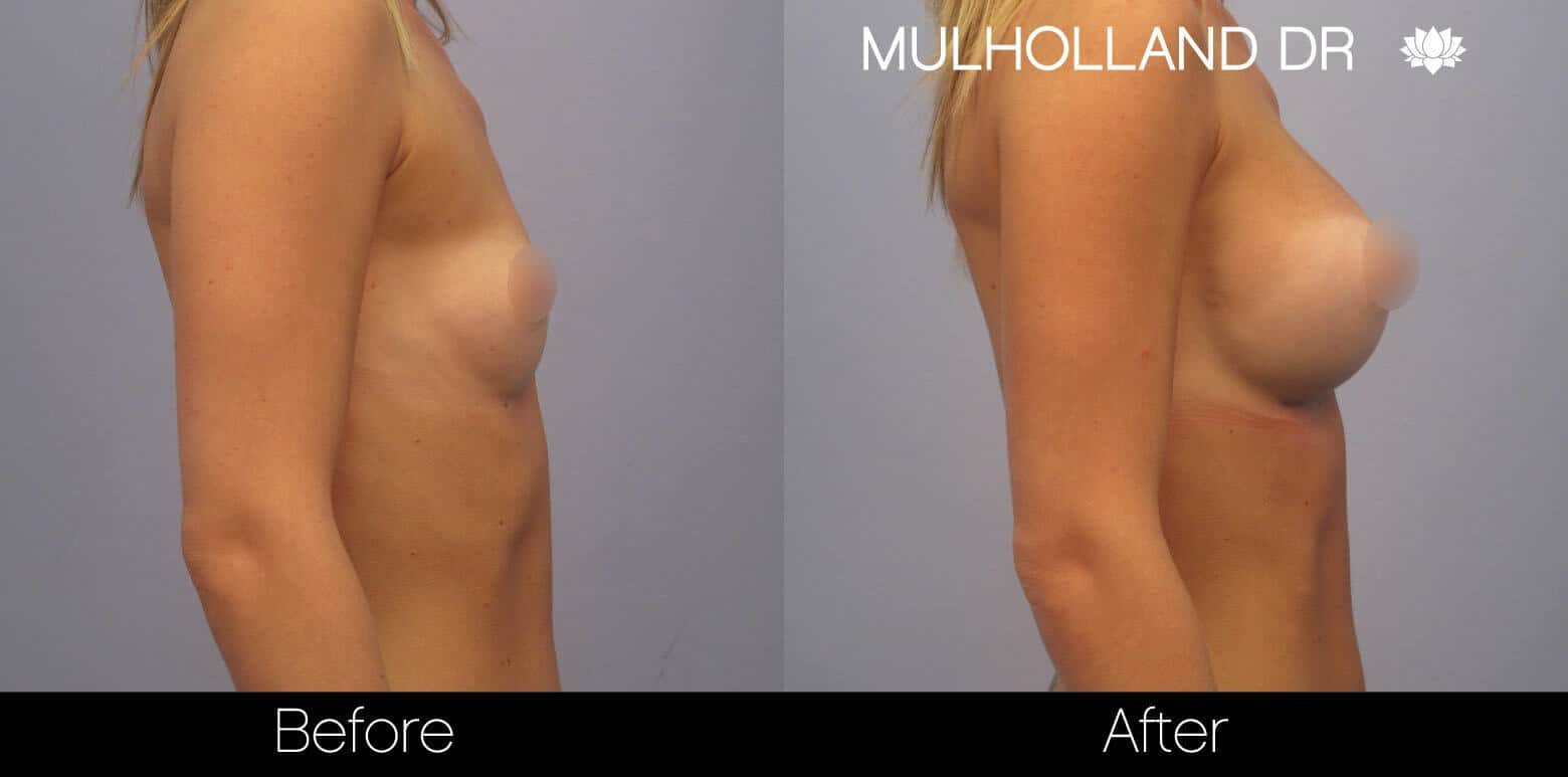 Breast Augmentation - Before and After Gallery – Photo 6