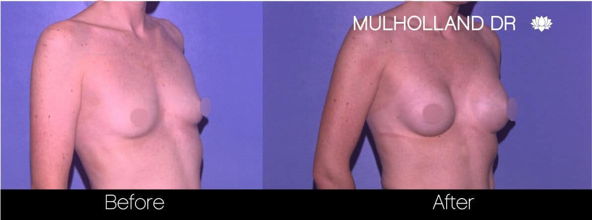 Breast Augmentation - Before and After Gallery – Photo 77