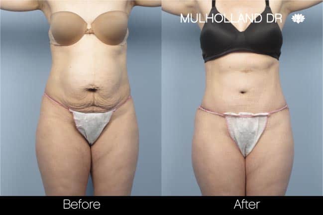 Mini Tummy Tuck Toronto - Partial Abdominoplasty