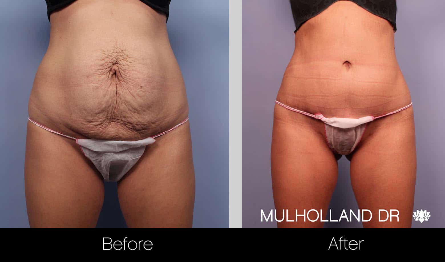 Tummy Tuck - Before and After Gallery – Photo 11