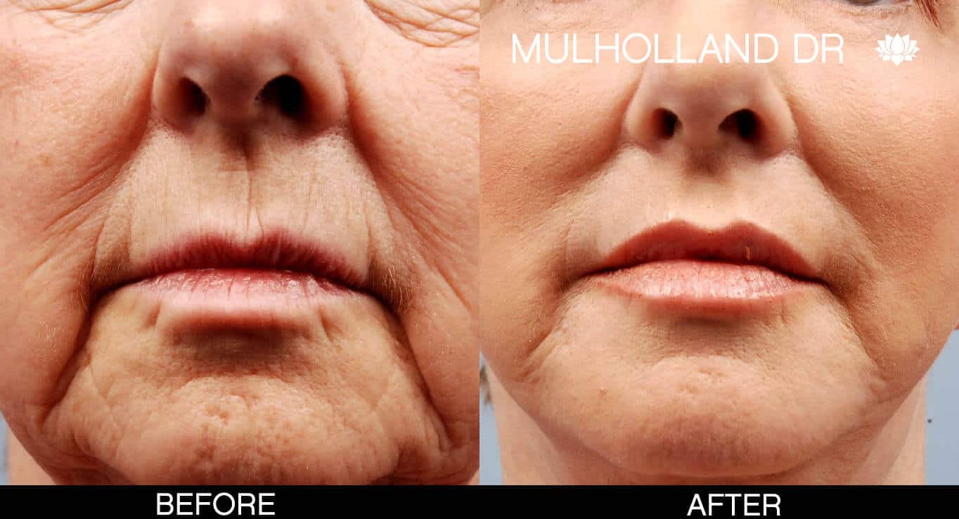 Fractional Erbium Laser - Before and After Gallery – Photo 23