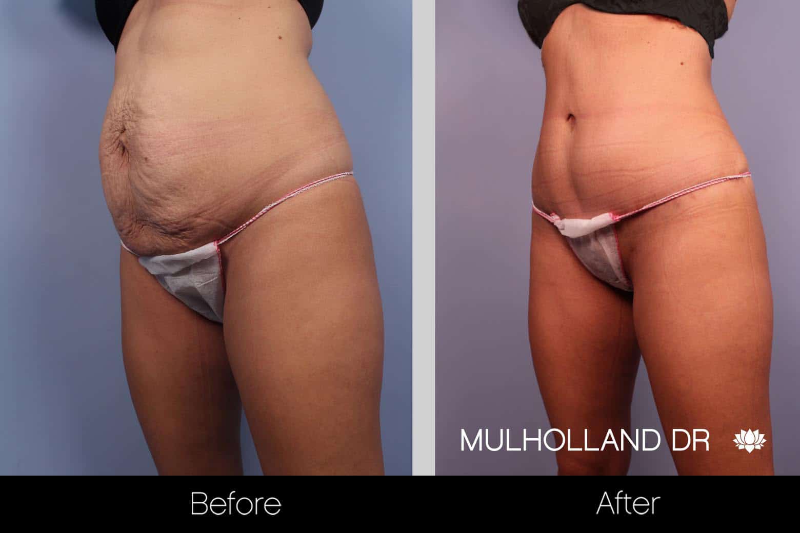 Tummy Tuck - Before and After Gallery – Photo 13