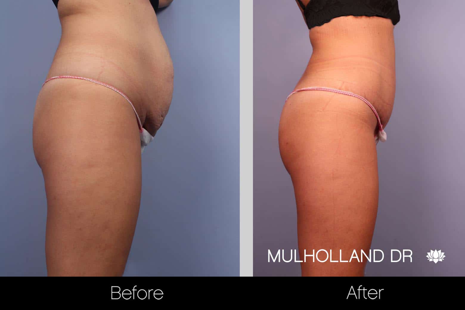Tummy Tuck - Before and After Gallery – Photo 14