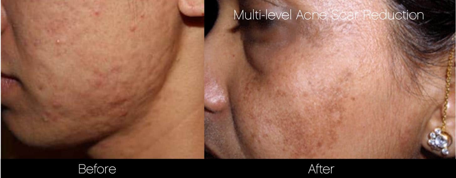Acne Scar Treatments - Before and After Gallery – Photo 14